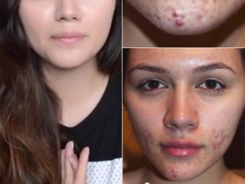 Anna Maria Damm berichtet über ihre Probleme mit Akne