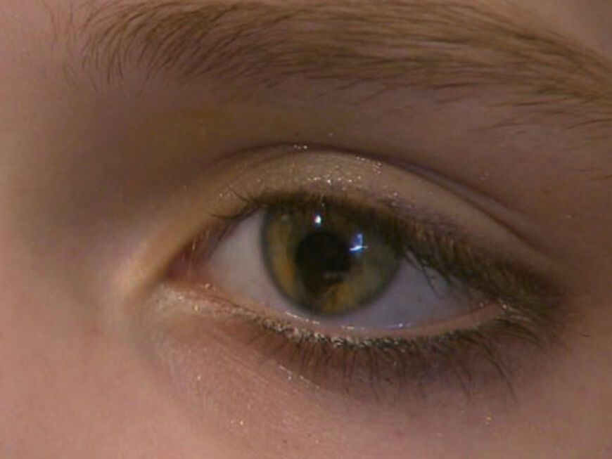 Bei der Erbkrankheit verlaufen die Pupillen weiter in die Iris hinein als normal