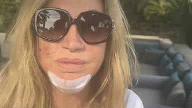 Carmen Geiss enthüllt mit sichtbaren Wunden im Gesicht Details zum Überfall