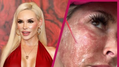 Daniela Katzenberger zeigt Verbrennungen im Gesicht