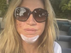 Carmen Geiss enthüllt mit sichtbaren Wunden im Gesicht Details zum Überfall