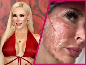 Daniela Katzenberger zeigt Verbrennungen im Gesicht