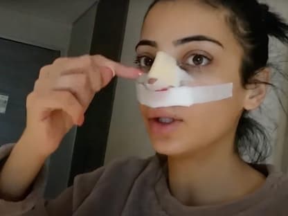 Dilara Kruse Ende 2023 nach ihrer Nasen-OP mit Verband
