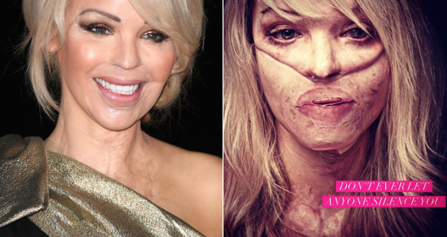 Saureopfer Katie Piper Nach 110 Ops Kaum Wiederzuerkennen Ok Magazin