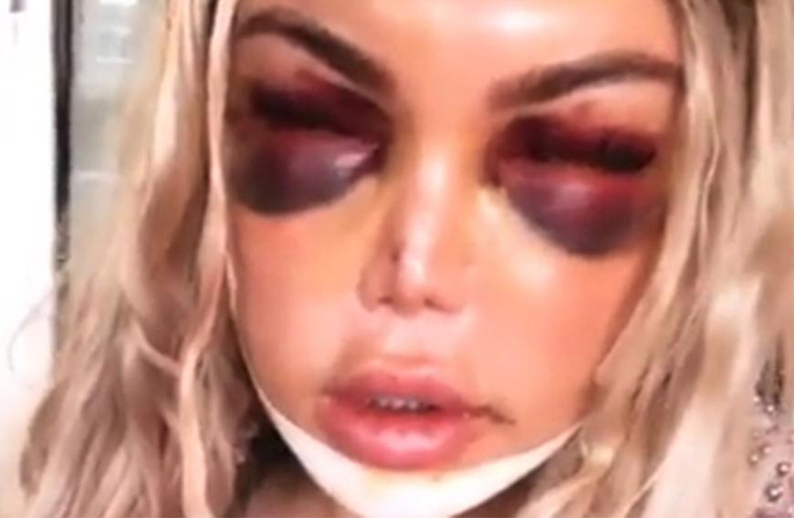 Rodrigo Alves Schock Foto Nach Op