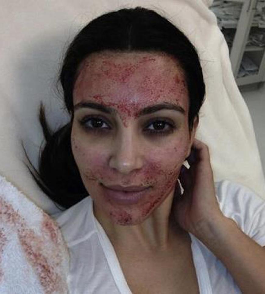 Wer schön sein will, muss bluten:´ Vampire Facelift