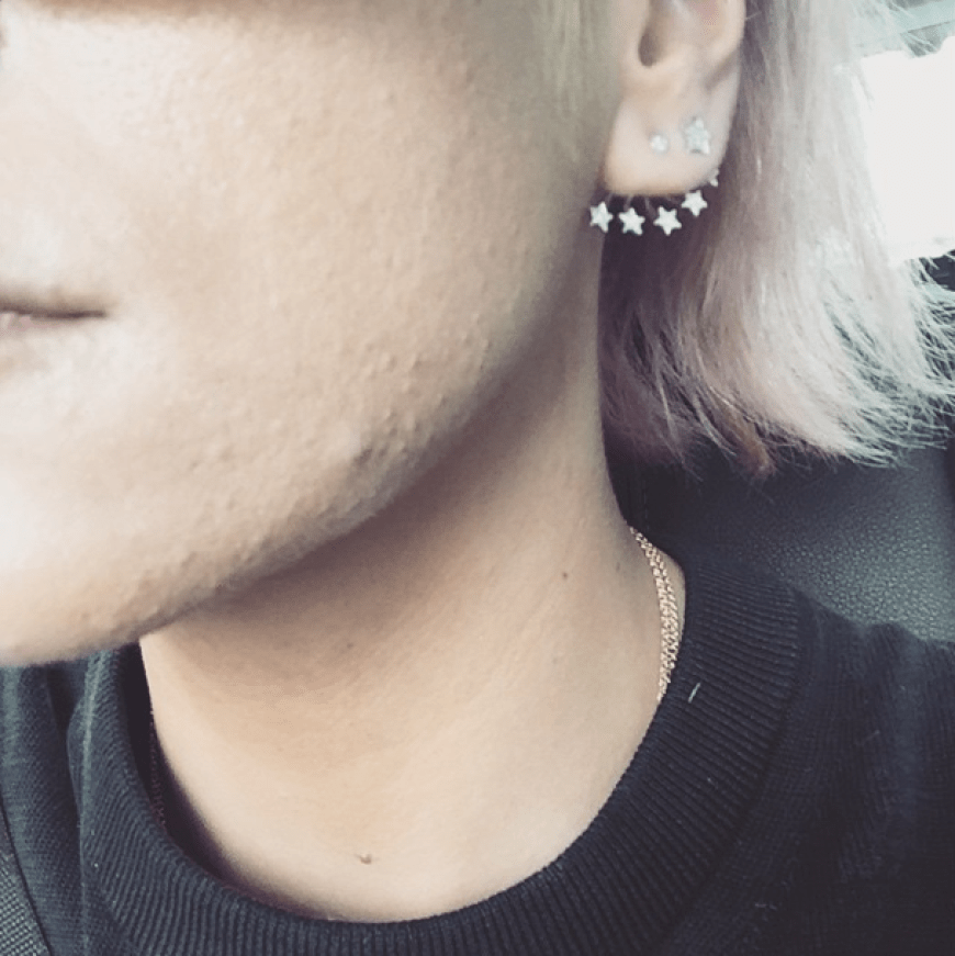 Großer Frust bei Sängerin Lily Allen, denn Akne lässt sich nicht so einfach bekämpfen.