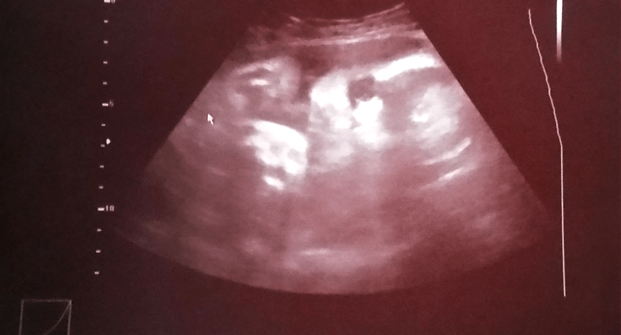 Auf Facebook teilt die werdende Mama die Ultraschallbilder ihres Ungeborenen.
