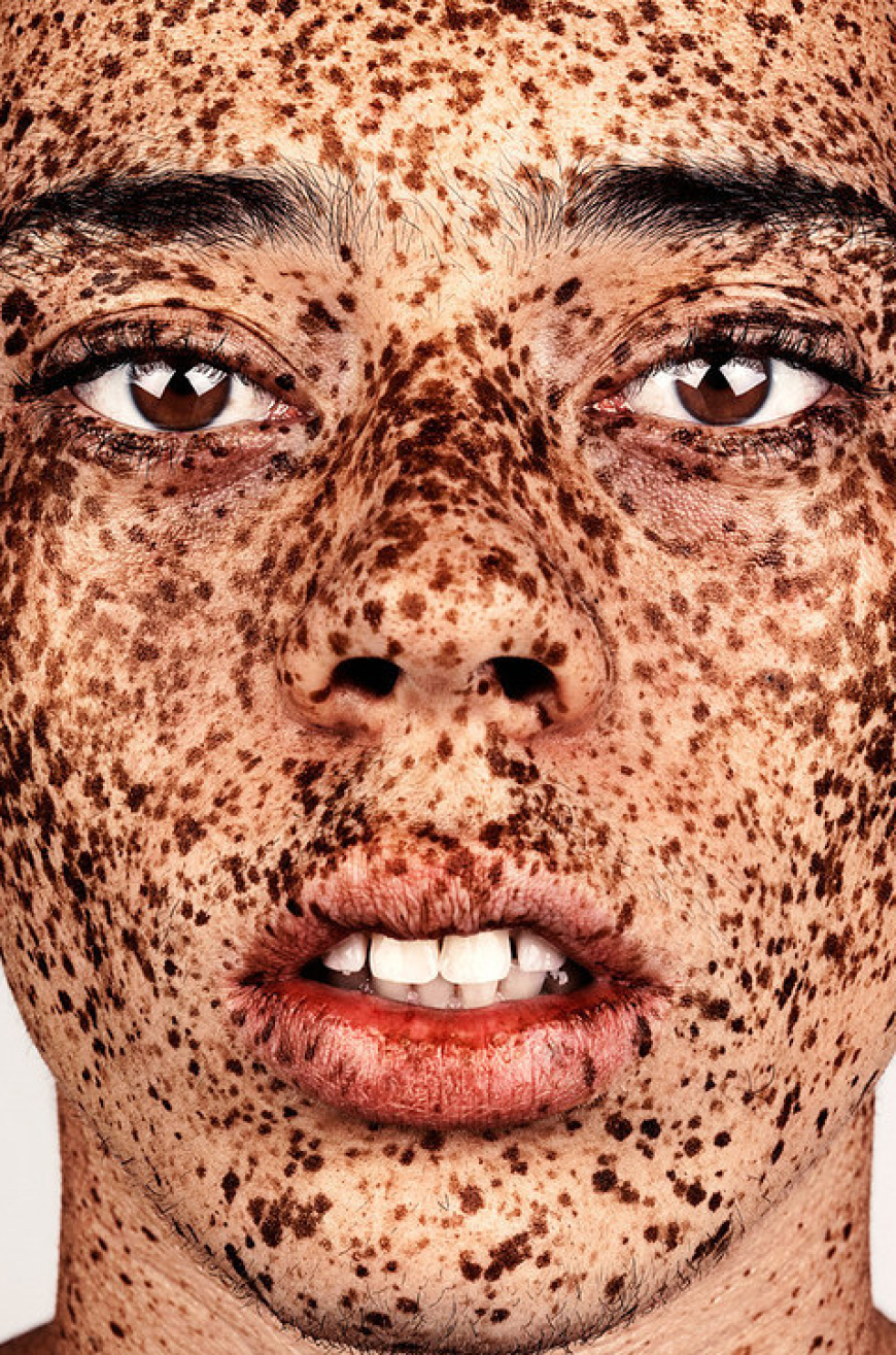 Brock Elbank - #Freckles