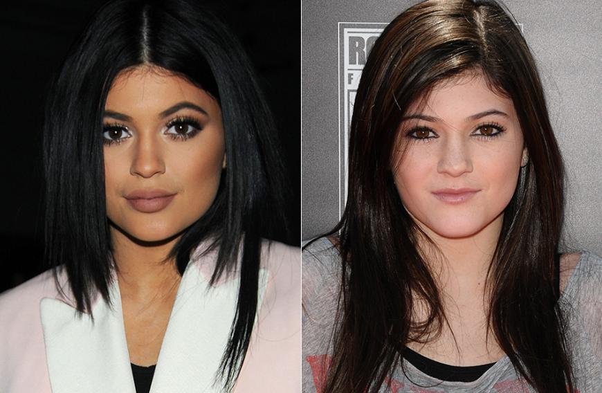 Kylie Jenner, 18: „Ja, ich habe Lippen-Filler. Es war etwas, was ich schon lange tun wollte“, erklärte die kleine Sis von Kim Kardashian ihre Lippenvergrößerung. „Ich habe absolut gar nichts gegen Beauty-OPs!“ Im Familien-Clan der Kardashians gehören Botox und Body-Pimper ja auch zum Erfolgsrezept ...