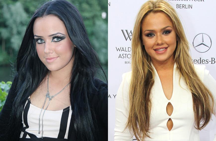 Kim Gloss, 23: Der ehemalige „DSDS“-Star ließ sich gerade Haarwurzeln verpflanzen für dichtere Augenbrauen und einen volleren Haaransatz. Mit OK! sprach sie nach ihrer Transplantation: „Ich hatte nach der OP sehr starke Schmerzen an der Entnahmestelle und dachte, ich halte es nicht aus. Jetzt freue ich mich schon auf das Endergebnis.“ Auf die Frage, ob sie nicht zu jung sei, sagt Kim: „Ich bin ja schon lange kein unbeschriebenes Blatt mehr in Sachen Beauty-OPs. Nun bin ich zufrieden mit meinem Körper und plane auch keine weiteren Eingriffe.“
