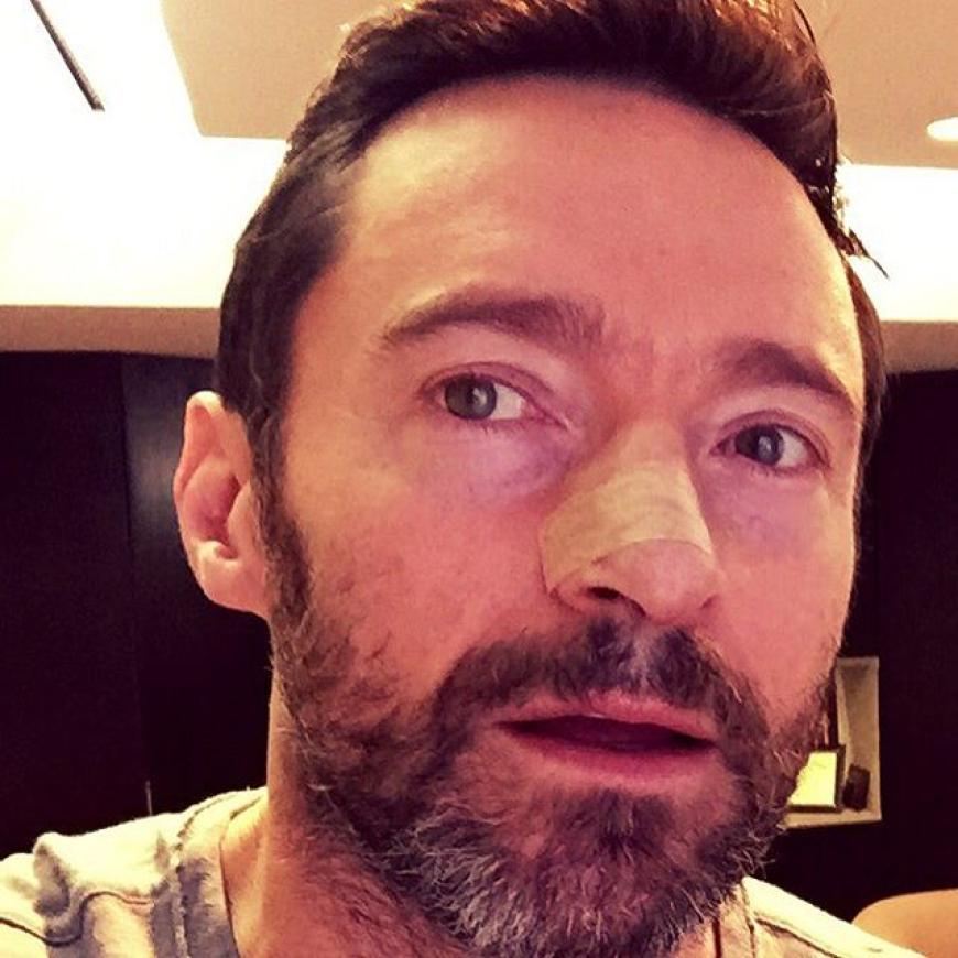 Hugh Jackman ließ sich in den vergangenen Jahren mehrmals wegen Hautkrebs behandeln.