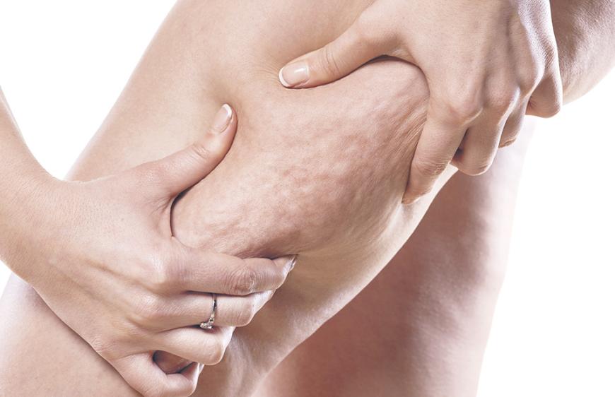 Cellulite ist ein häufiges Problem, unter dem auch schon viele junge Frauen leiden. Ursache sind Fettzellen aus dem Gewebe der Unterhaut, die an die Hautoberfläche drücken – die für die Orangenhaut typischen Dellen werden sichtbar.