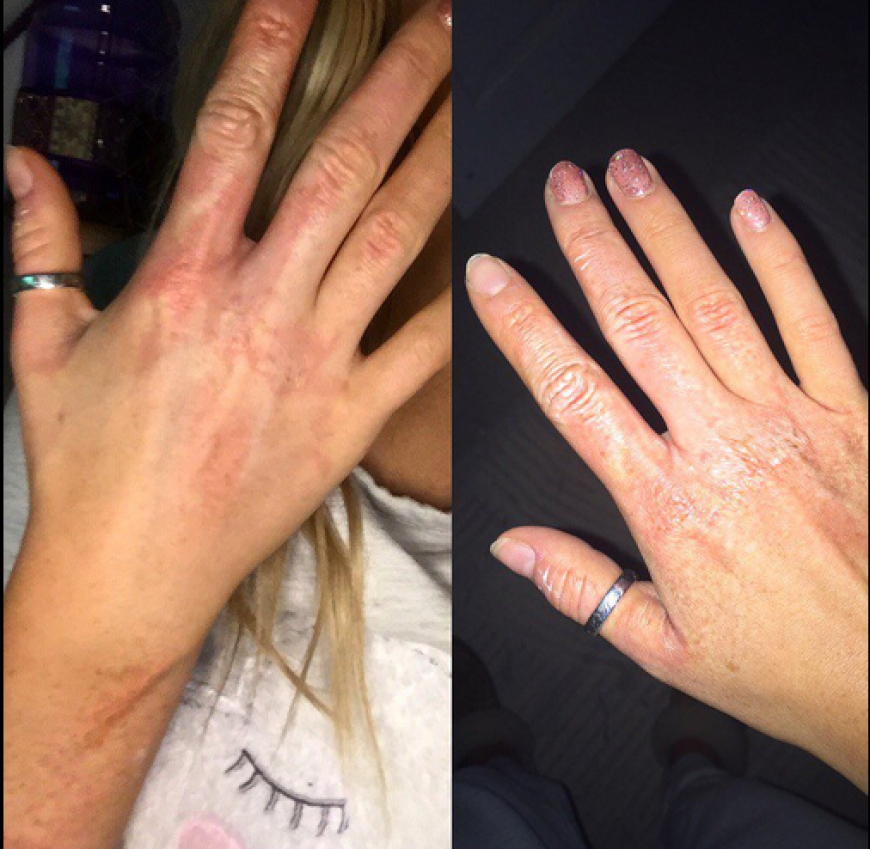 Und dabei hat sich die Sängerin ziemlich fies die Hand und den Arm verbrannt.