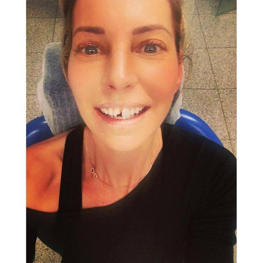 Kleine Haushalts-Panne: Giulia Siegel hat sich den Schneidezahn abgebrochen.
