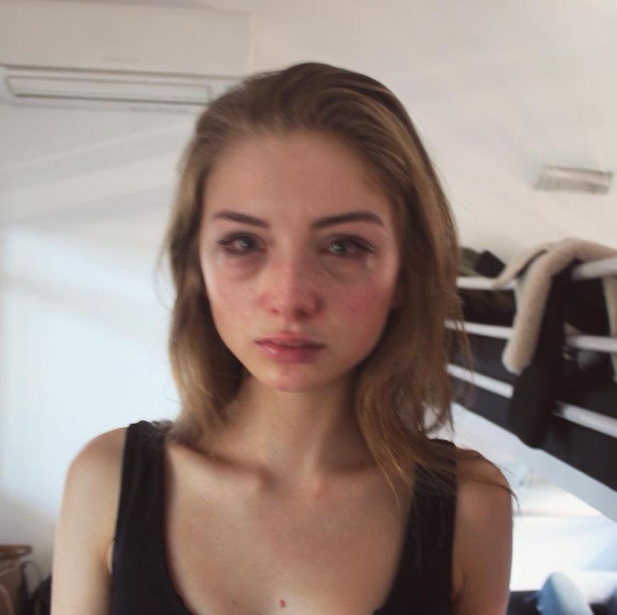 Allergie-Schock: Julia Wulf kränkelte bei GNTM, war jedoch hart im Nehmen. Die Jury schickte sie dennoch nach Hause.