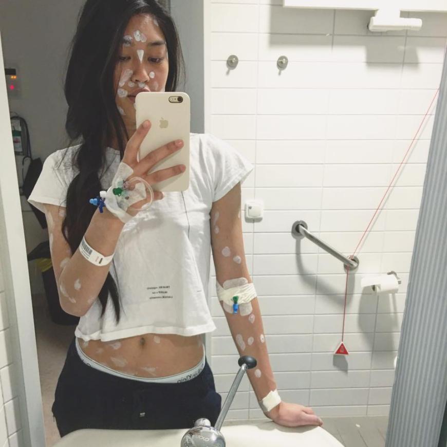 Anuthida Ploypetch ist mit 18 Jahren an Windpocken erkrankt.
