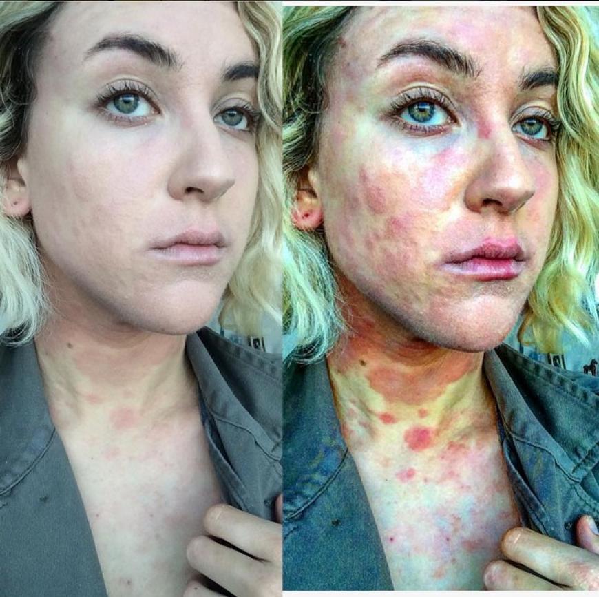 Mutiger Schritt: Ciena veröffentlichte auf Instagram ein Bild von sich, das sie während eines Psoriasis-Schubs zeigt.