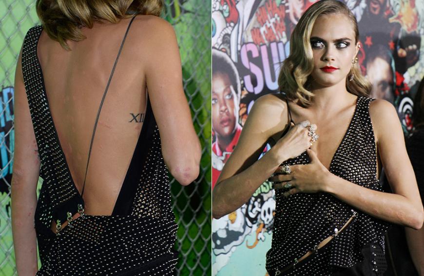 Cara Delevingne leidet an Schuppenflechte. Die ehemalige Lagerfeld-Muse ist jetzt Schauspielerin. Doch hinter der schönen Fassade scheint bei der Beauty ein bitterer innerlicher Kampf zu toben.
