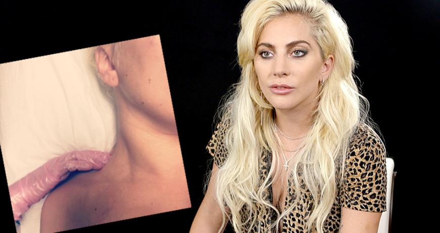 Chronische, körperliche Schmerzen sind die Folge von Lady Gagas psychischem Leiden.