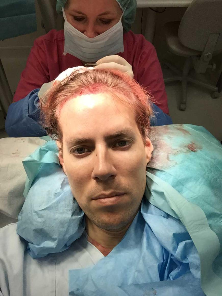 Gegen eine hohe Stirn und Geheimratsecken unterzog sich Jens einer Haartransplantation. Dafür werden einige Haare vom Hinter- auf den Vorderkopf verpflanzt.