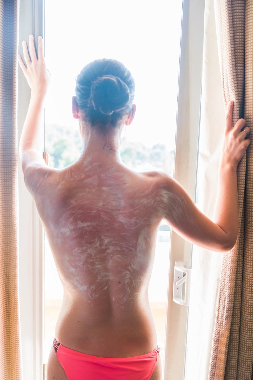 Mit der Sonne übertrieben? Das hilft wirklich bei Sonnenbrand! - Bild 1