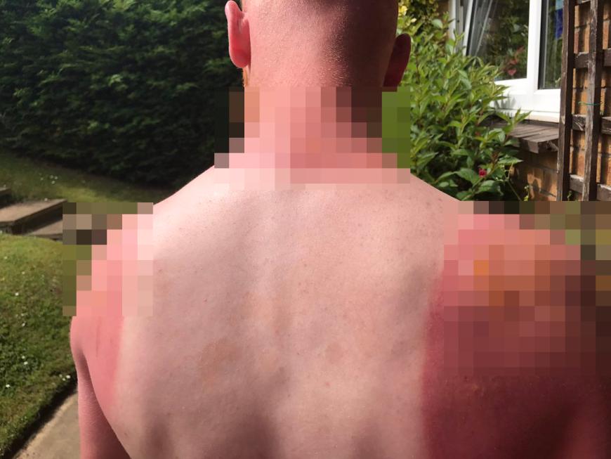 "Mein voller Ernst, bitte verwendet Sonnencreme" - Mit schockierenden Aufnahmen warnt ein Schotte bei Twitter vor den Konsequenzen eines Sonnenbrandes.