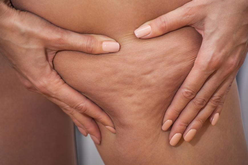 Cellulite haben viele Frauen, doch die Mittel dagegen sind begrenzt.