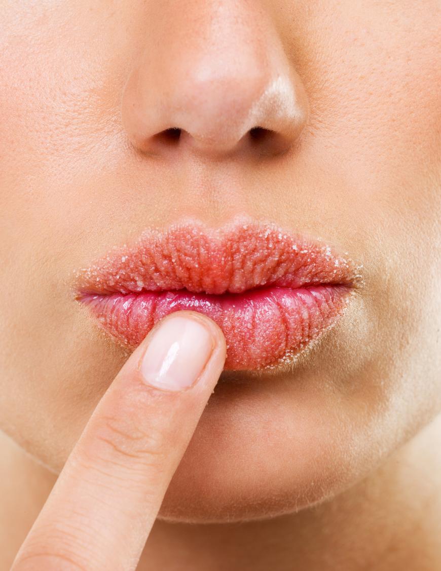 Brennende, spröde Lippen gehören mit den nachfolgenden sechs Tipps endlich das ganze Jahr über der Vergangenheit an.