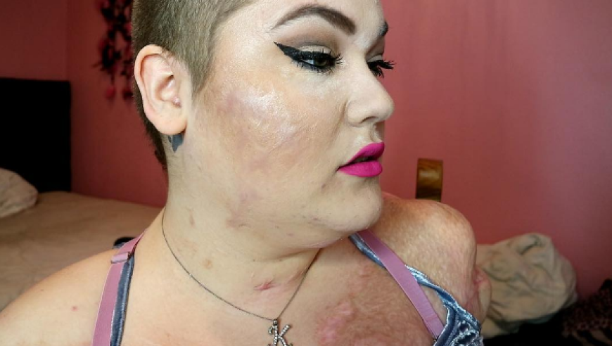 Kaitlyn Dobrow besitzt zwar keine Arme und Beine mehr, dafür aber sehr viel Talent und Lebenswillen.