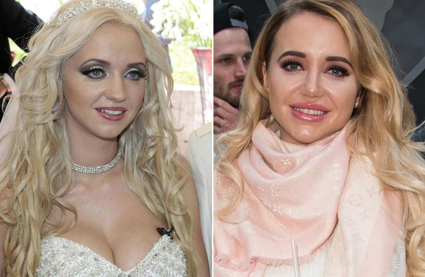 Gerade erst hat sich Cathy Lugner den Wunsch nach einer neuen Nase erfüllt: Im Dezmeber 2017 legte sich die 28-Jährige unters Messer. Im Vergleich zum Jahr 2014, als das Playmate den Baulöwen Richard Lugner, 84, geheiratet hat, ist ein deutlicher Unterschied zu erkennen. Auffällig: Auch die Mundpartie erscheint deutlich praller - Lippen-Injektionen scheint Cathy also auch nicht abgeneigt zu sein.