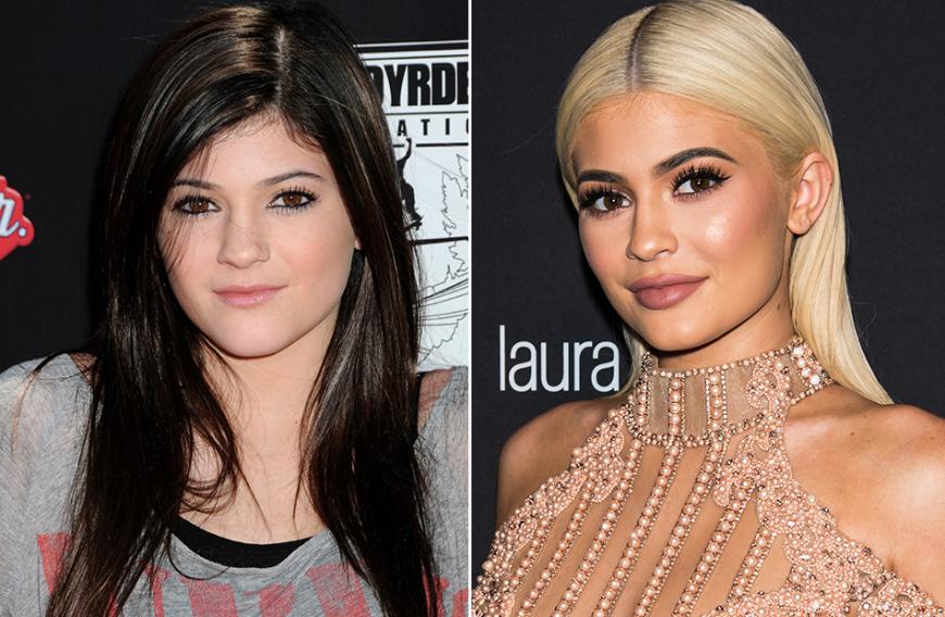 Es gibt nur ein Familienmitglied im Kardashian-Jenner-Klan, das mit optischen Veränderungen noch mehr von sich reden gemacht halt als Oberhaupt Kim Kardashian: Das Küken der Familie, Kylie Jenner. 2010 hätte wohl niemand damit gerechnet, dass sich die heute 20-Jährige ein krasses Beauty-Imperium aufbauen würde. Das wohl größte Gesprächsthema der letzten Jahre waren immer wieder die Lippen-Injektionen des KUWTK-Stars. Anfangs bestritt Kylie diese noch, mittlerweile ist der Eingriff kein Geheimnis mehr. Auch bei Brust und Po soll die Unternehmerin nachgeholfen haben, bestätigt hat sie dies jedoch nie.