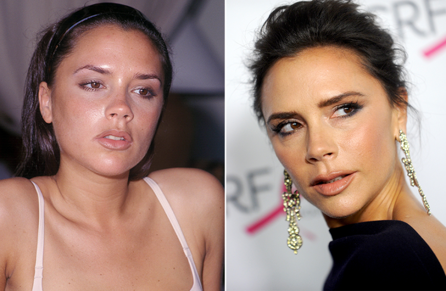 Victoria Beckham soll ein Implantat im Bereich des Nasenrückens tragen - im Vergleich zu früher ist dieser heute deutlich breiter.