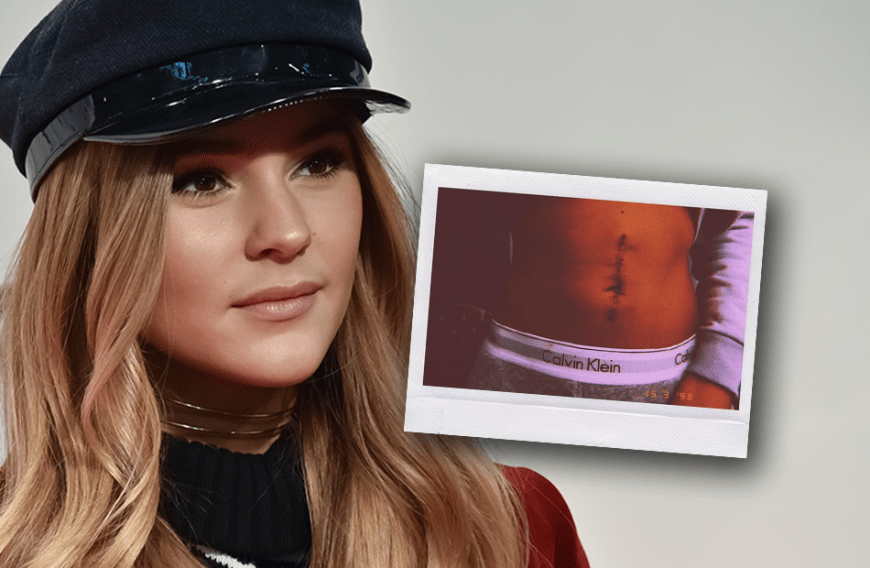 Stefanie Giesinger steht offen zu ihrer Narbe - und präsentiert sie jetzt nur eine Woche nach der OP der ganzen Welt im Netz.