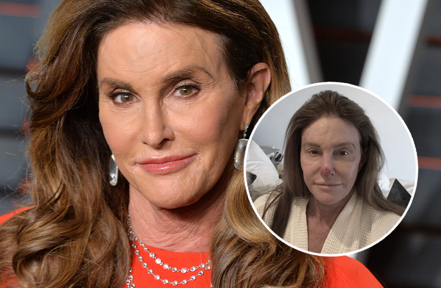 Wir hätten Caitlyn Jenner fast nicht erkannt! Auf ihrer Nase klafft eine große, offene Wunde.