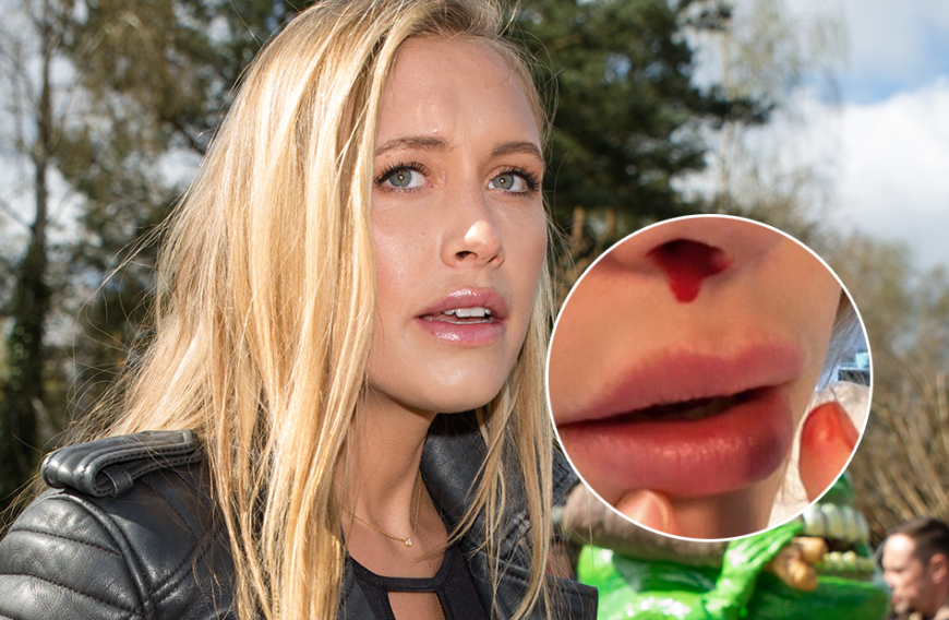 Alena Fritz zeigt sich nun herrlich ungeschönt auf Instagram - mit einer blutigen Nase!