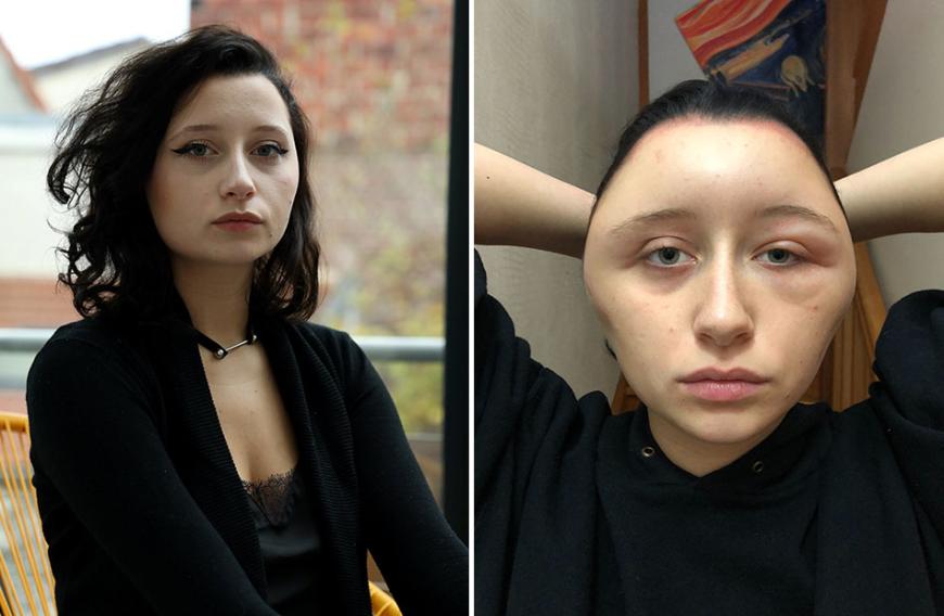 Ein Schock für Estelle aus Frankreich. Auf dem linken Bild ist sie mit einem normalen Kopfumfang zu sehen. Das rechte Bild zeigt sie, nachdem sie sich die Haare gefärbt hat!