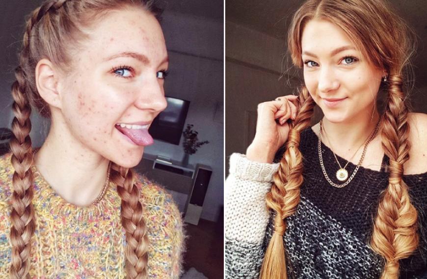 Als Model wird von ihr erwartet, immer perfekt auszusehen - doch Hanna steht offen zu ihren Hautunreinheiten.