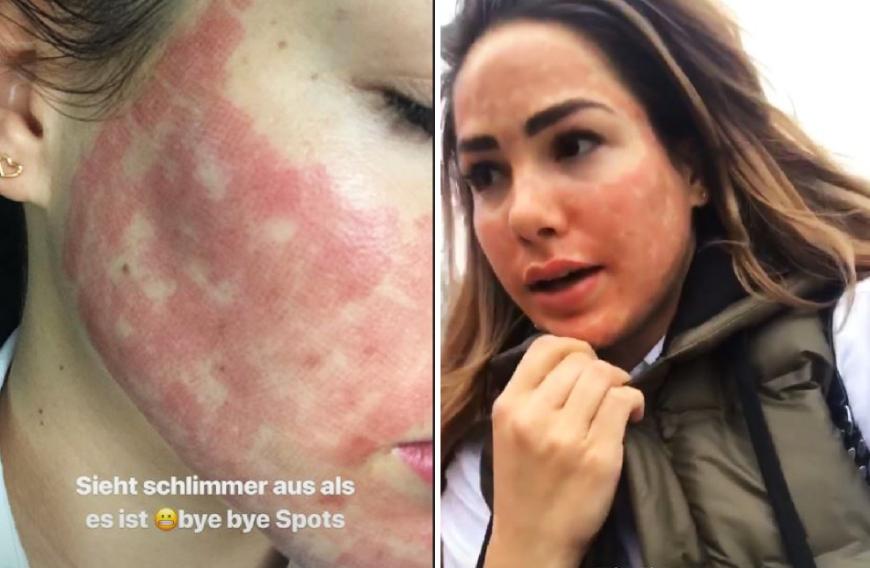 Auf ihrem Instagram-Account offenbarte die Reality-TV-Darstellerin ihre Hautprobleme.