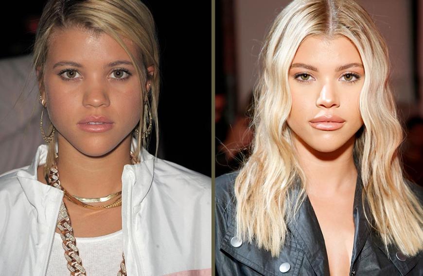 Vorher-Nachher! Bild links: 2017 ; Bild rechts: 2019! Die Nase schmaler, die Lippen noch voluminöser, das Kinn etwas markanter: Sofia scheint Stammgast beim Beauty-Doc zu sein.