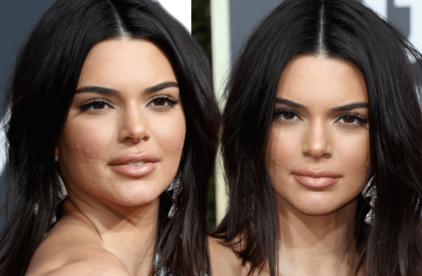 Auch Supermodel Kendall Jenner neigt hin und wieder zu Akne-Ausbrüchen. Wir verraten dir, welcher Fehler die Unreinheiten begünstigt.