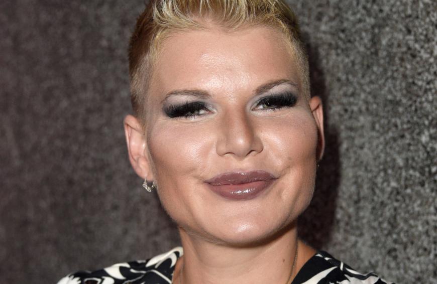 Melanie Müller ist frisch geliftet.
