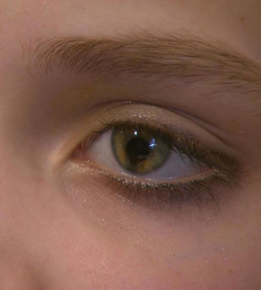 Bei der Erbkrankheit verlaufen die Pupillen weiter in die Iris hinein als normal
