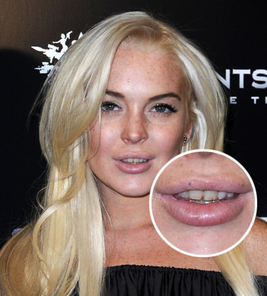 Früher: Ekel-Alarm bei Lindsay Lohan. Trotz perfekter Haare und Make-up stehlen ihre ungepflegen Zähne ihr die Show