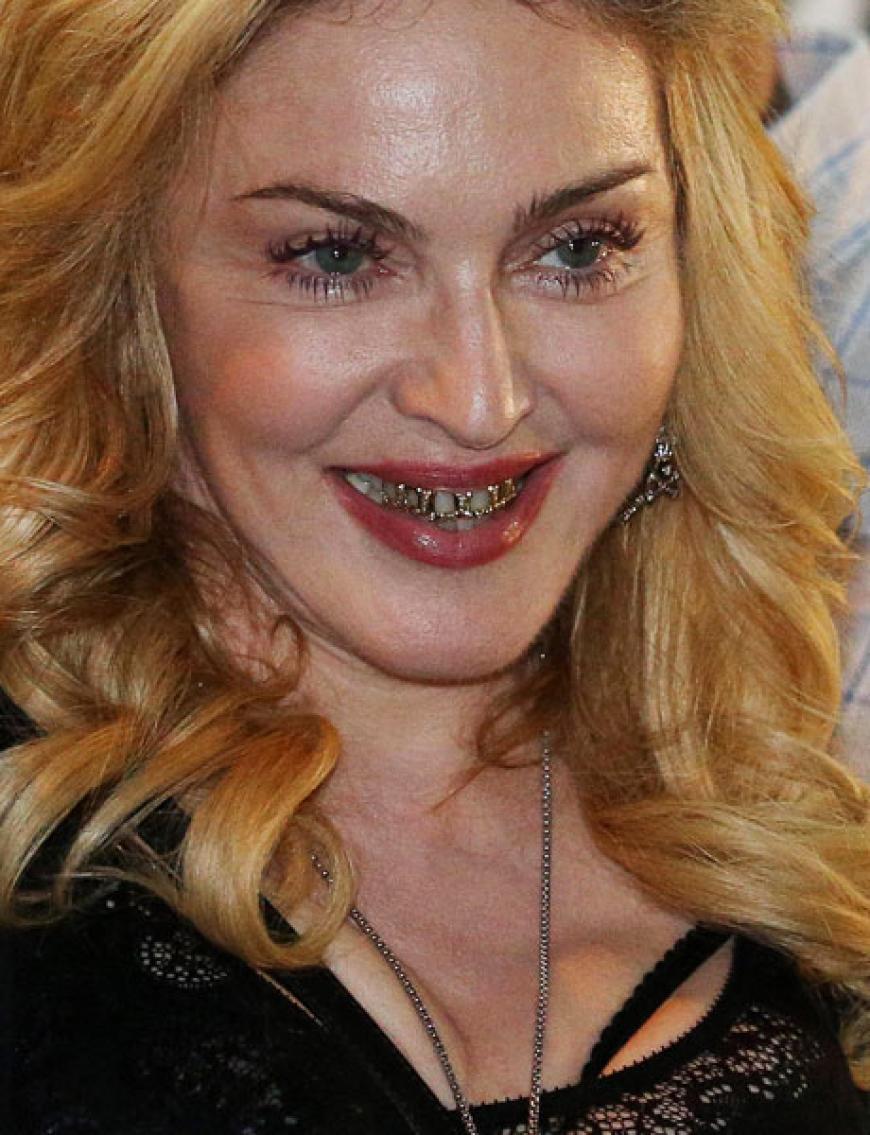Doch muss das sein? Der Zahnschmuck ist eigentlich ein prolliges Status-Symbol in der Hiphop-Szene. Nun schmücken sich auch viele Popstars mit den goldenen Zähnen