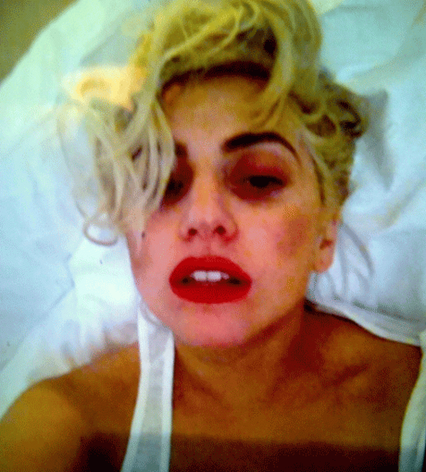 Aua! Lady Gaga bekam bei einem Konzert eine Eisenstange an den Kopf und trägt nun Veilchen