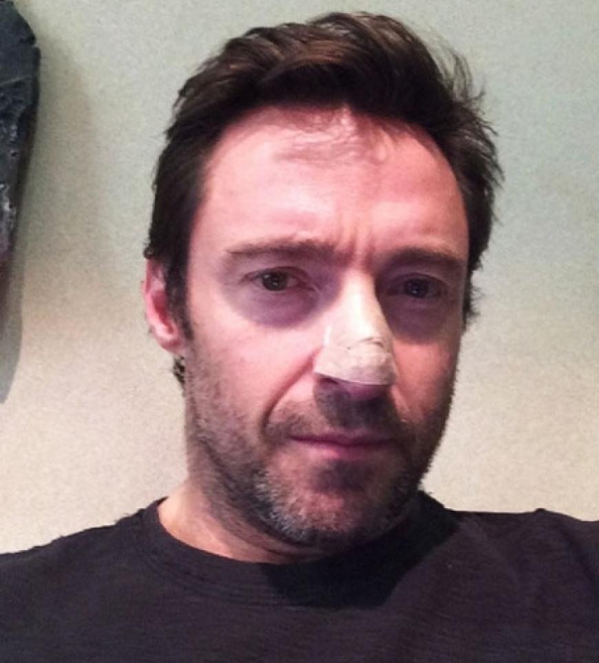 Mit diesem Schnappschuss sorgte Frauenstar Hugh Jackman für große Sorge. Er erkrankte an Hautkrebs und ließ sich eine verdickte Stelle auf der Nase entfernen