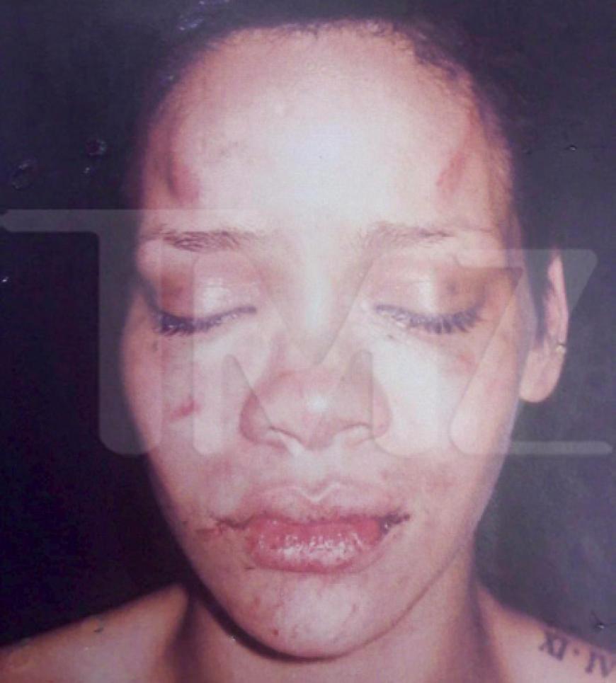 Erschreckende Bilder: Rihanna mit Wunden und blauen Flecken im Gesicht. Das Ergebnis von Chris' brutalem Übergriff