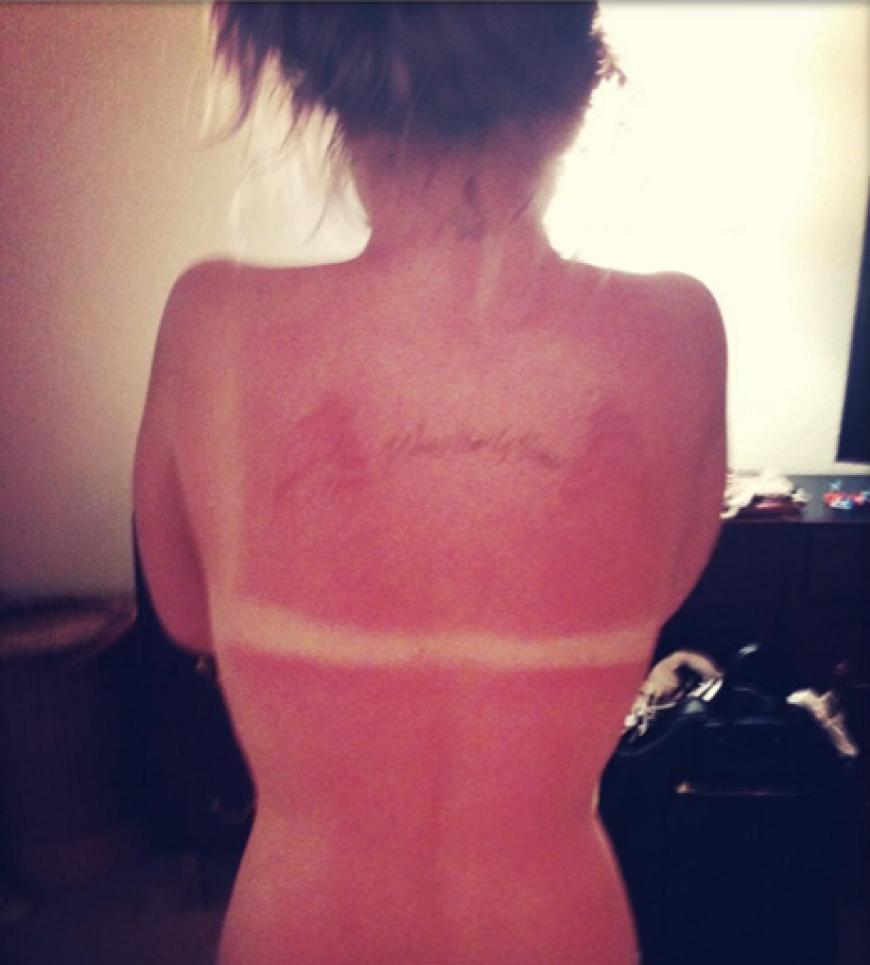Schmerzhaftes Sonnenbaden. Das Ergebnis twitterte Kelly Osbourne und präsentierte ihre krebsroten Sonnenbrand