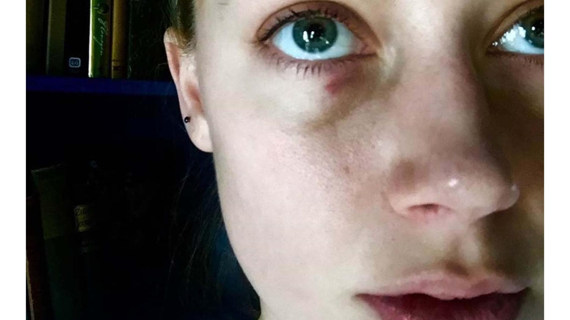 Amber Heard: Prügel-Fotos! Hat Johnny Depp sie so zugerichtet?
